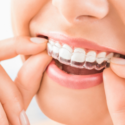 Invisible Aligners