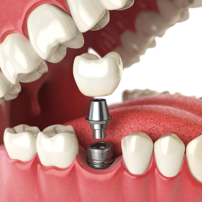 Teeth Implant